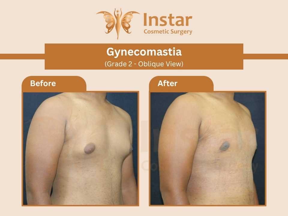 Gynecomastia-Grade 2-Oblique View